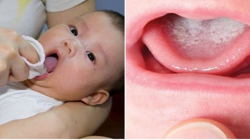 trẻ sơ sinh bị trắng lưỡi