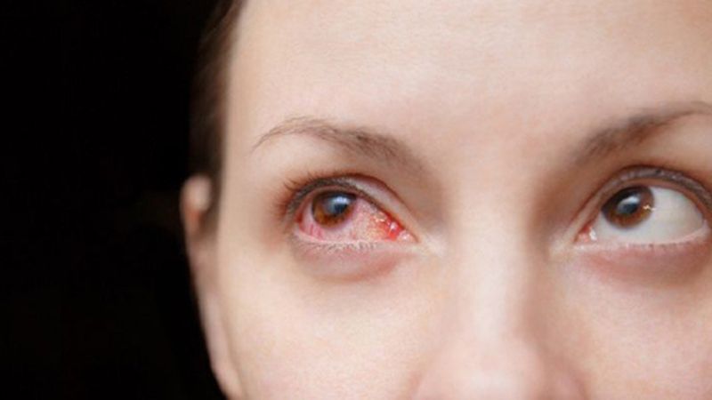 triệu chứng đau mắt đỏ