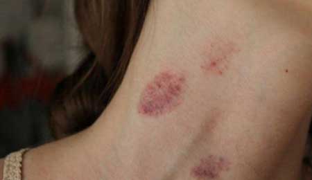 Hickey là gì? Cách để hickey an toàn trên cơ thể đối phương