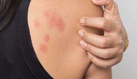 15+ mẹo chữa dị ứng mẩn ngứa từ nguyên liệu thiên nhiên hiệu quả