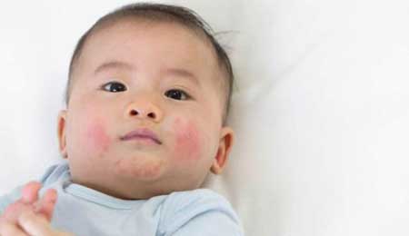 Mẹo chữa dị ứng thời tiết cho trẻ cực hay mà bạn nên biết