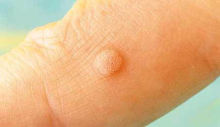 Khám phá 15 mẹo chữa mụn cóc dân gian hiệu quả và đơn giản